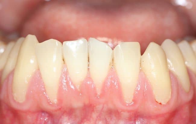 Tooth decay can lead to gum recession and exposed root surfaces