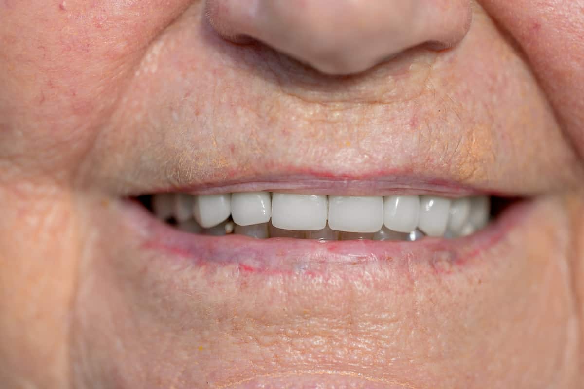 Close-up of cleaned teeth on an elderly patient after mobile dental treatment.