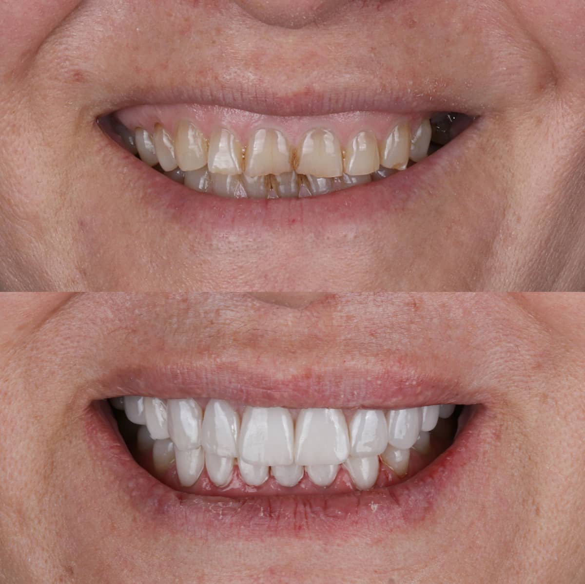 Close-up before and after image of an elderly patient's smile showing improvement with dental crowns.