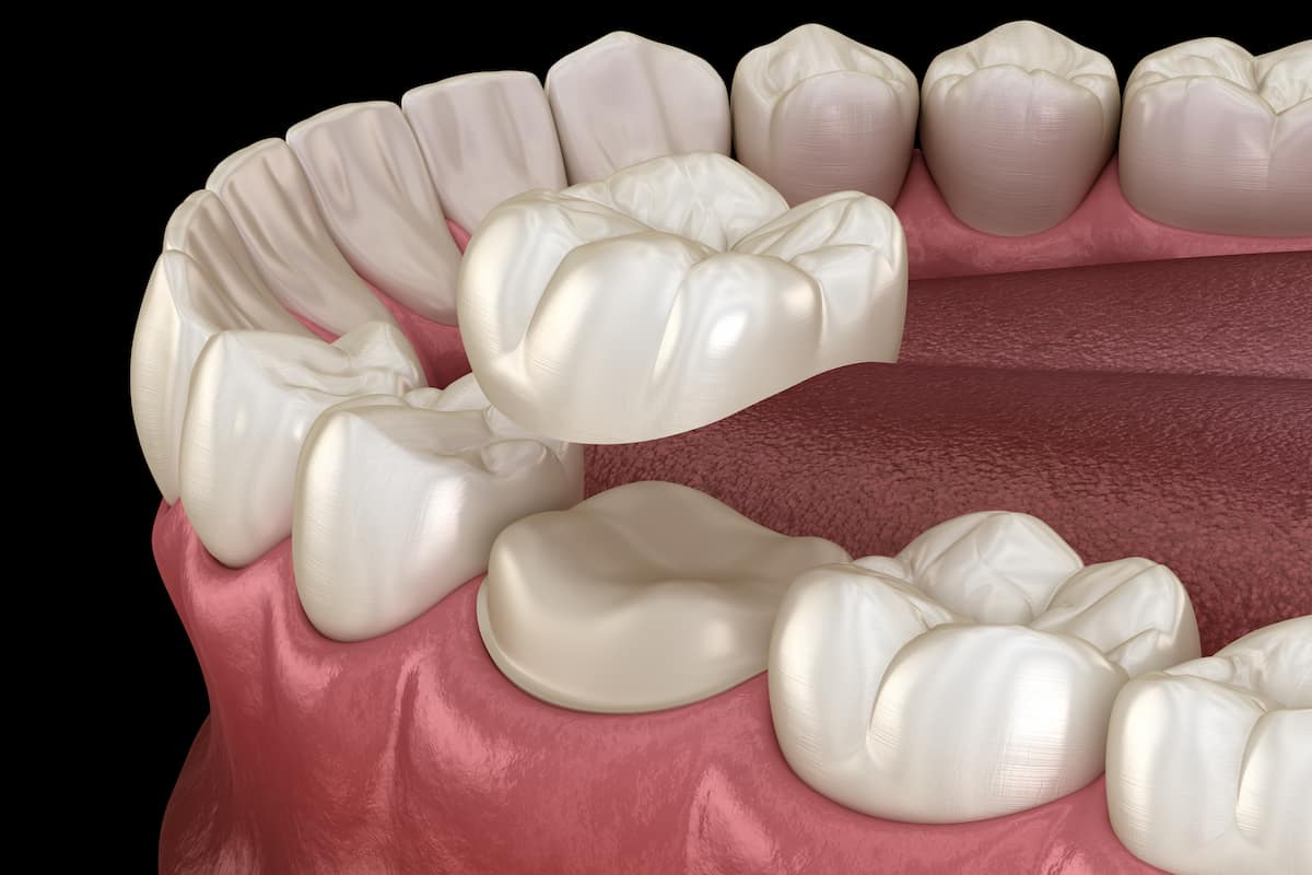3D illustration of a dental crown being placed over a tooth