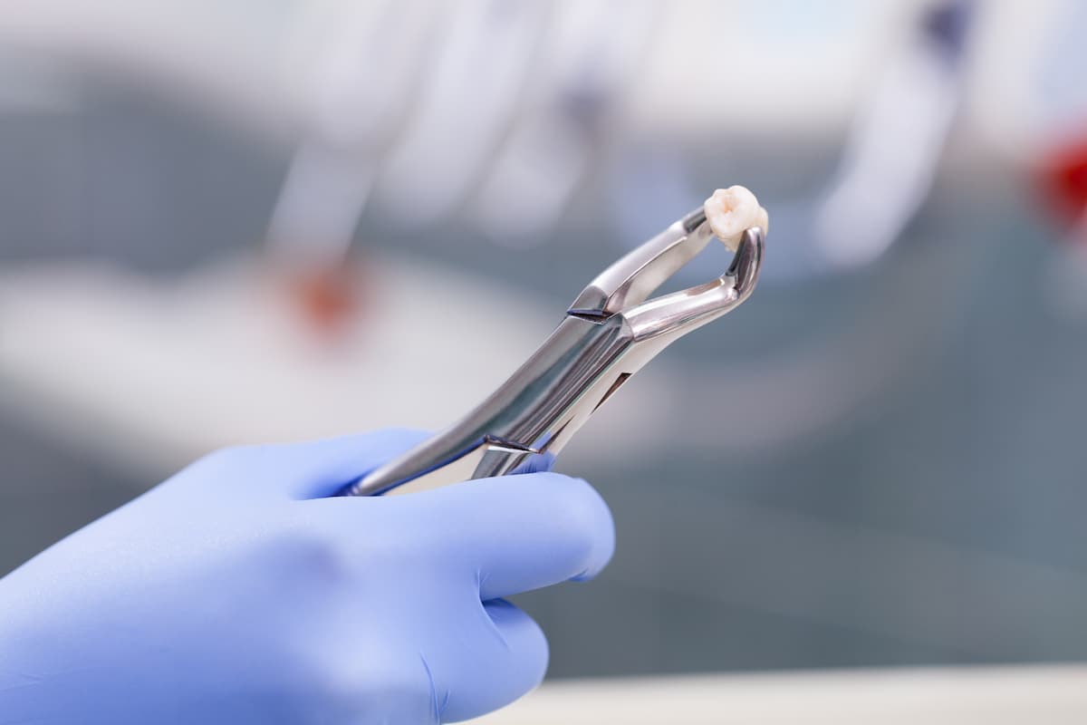 Close-up of a dentist’s gloved hand holding a freshly extracted tooth with dental forceps.